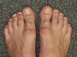 This image has an empty alt attribute; its file name is hallux-rigidus.jpg