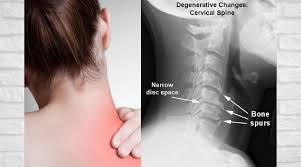 Neck pain: Cervical Spondylosis. What is Spondylosis & do you treat it?