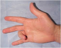 Kézsebészet - Pattanó ujj – Euritmia-Medic Sebészeti Rendelő